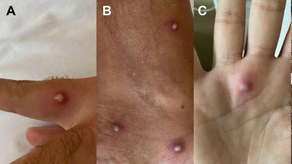 Large spots on the body of a man who was found to be suffering from monkeypox. Pic: Journal of Infection